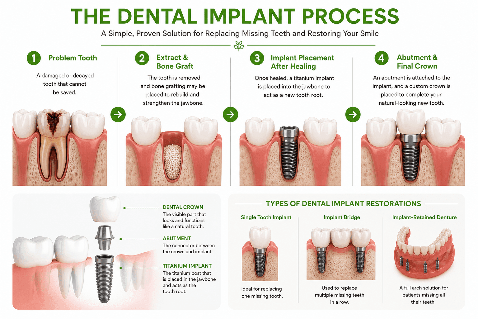 Four-step dental implant process showing a damaged tooth, extraction and bone grafting, implant placement after healing, and the final crown, plus implant components and restoration options.